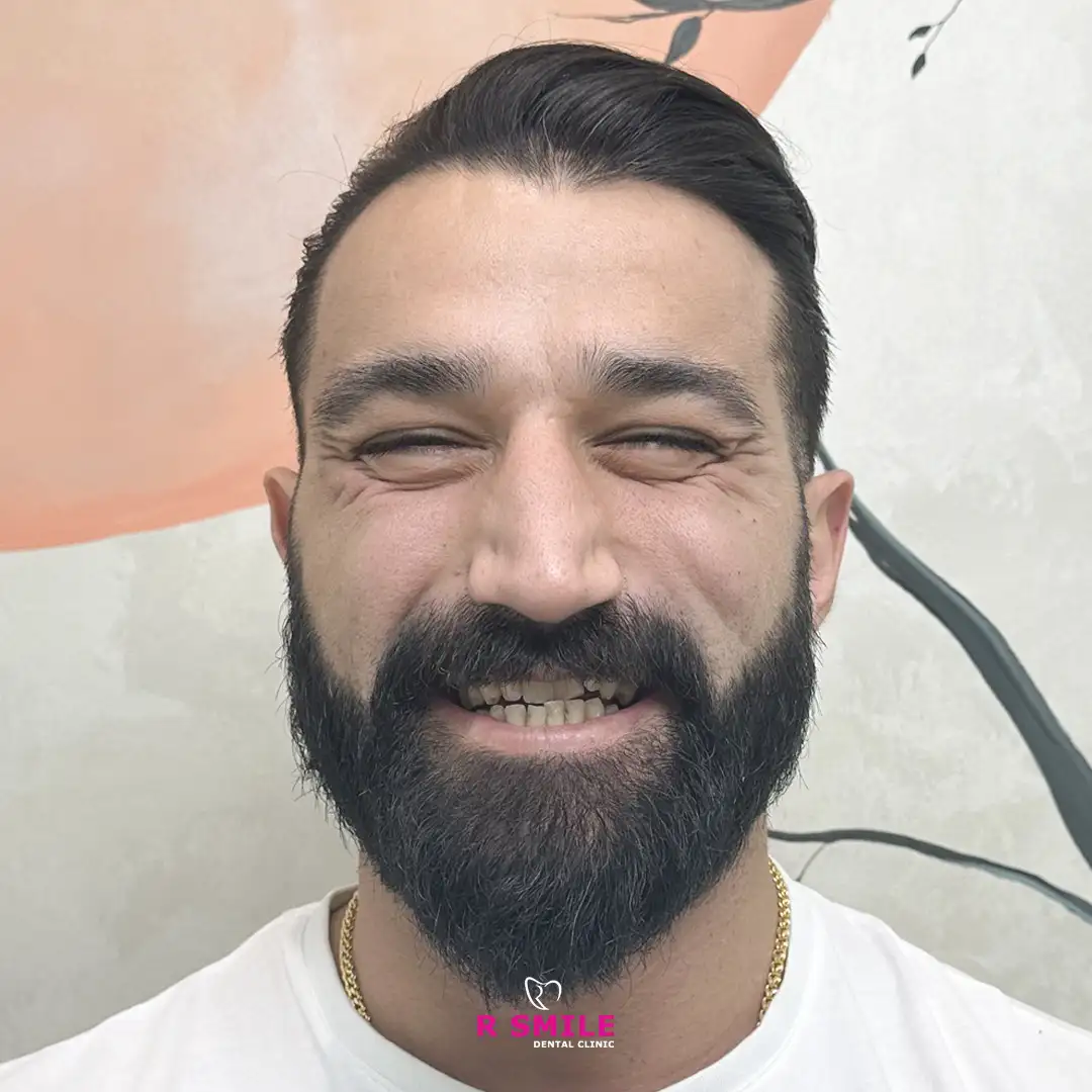 R Smile Dental Clinic ile yapılan diş çekimi öncesi ve sonrası hasta fotoğrafı