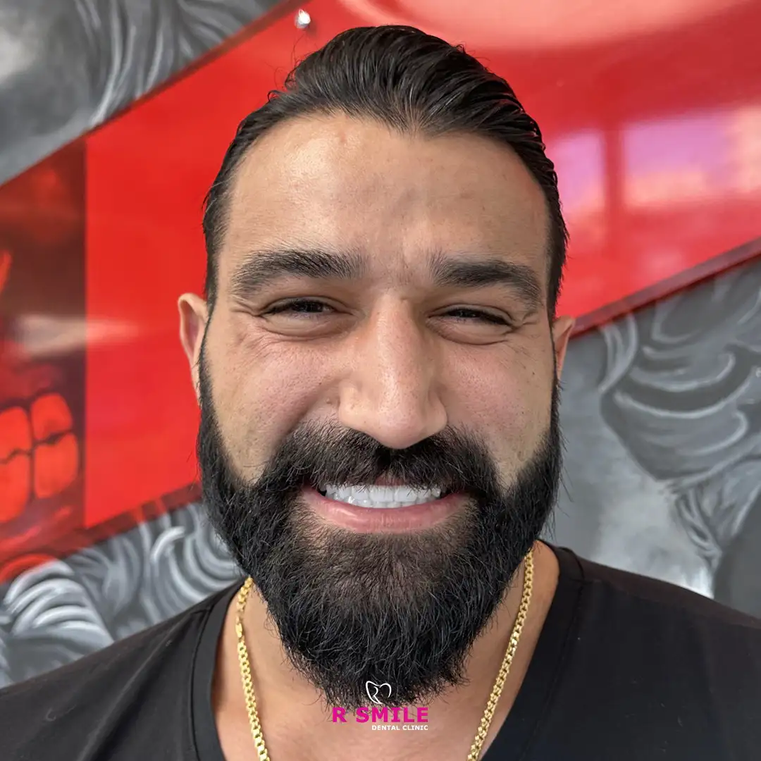 R Smile Dental Clinic ile yapılan diş çekimi öncesi ve sonrası hasta fotoğrafı