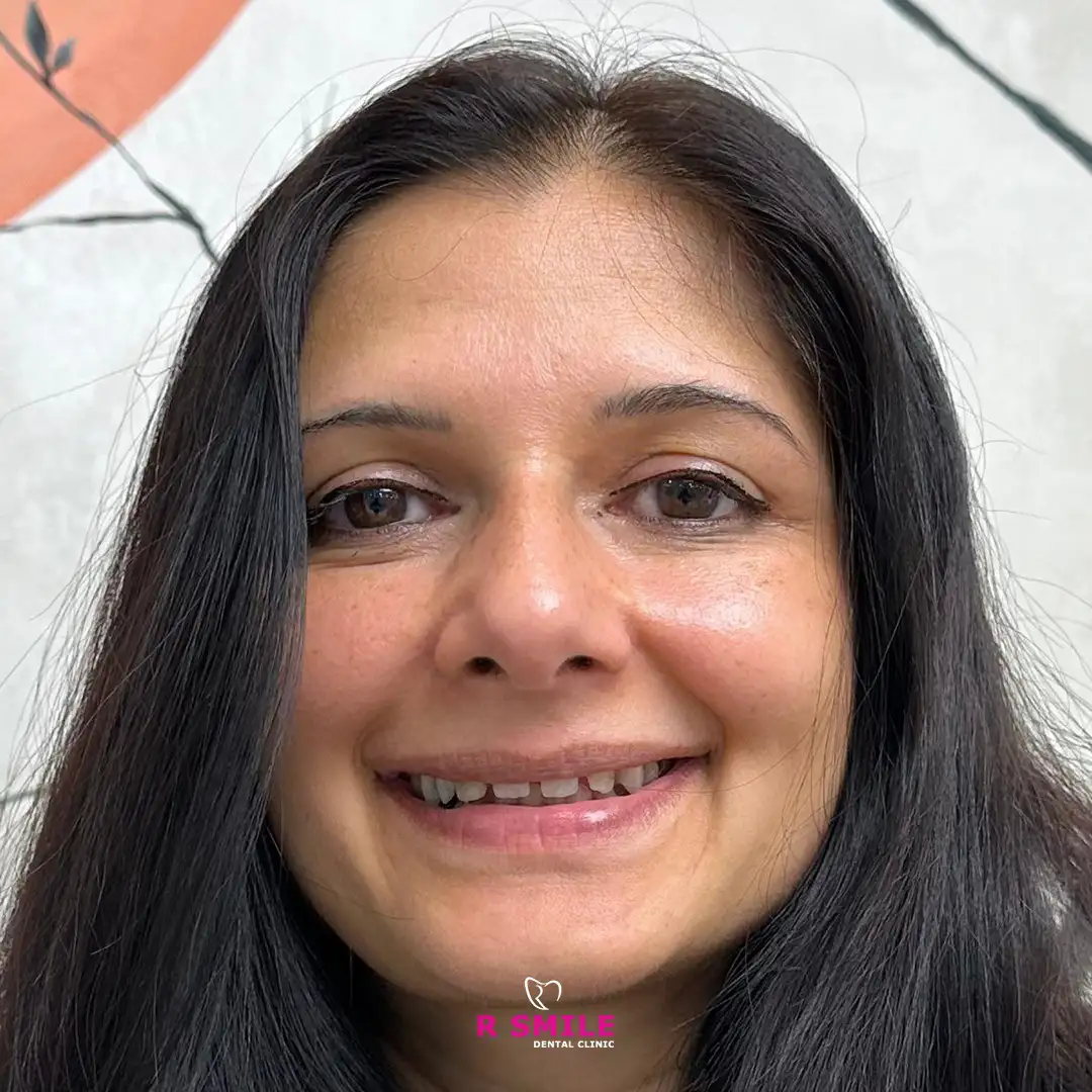 R Smile Dental Clinic ile yapılan diş çekimi öncesi ve sonrası hasta fotoğrafı