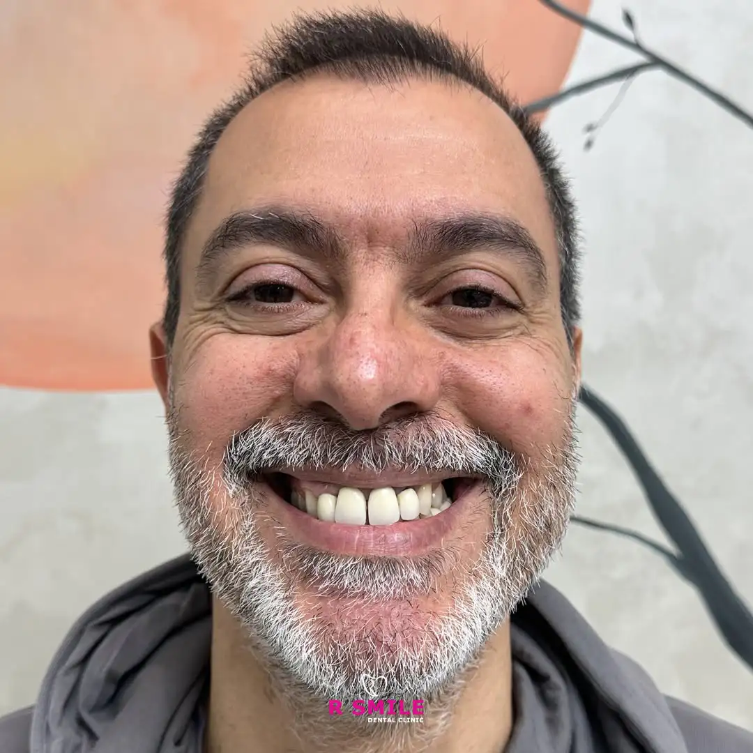 Diş estetiği ve gülüş tasarımı sonucu R Smile Dental Clinic hasta görseli