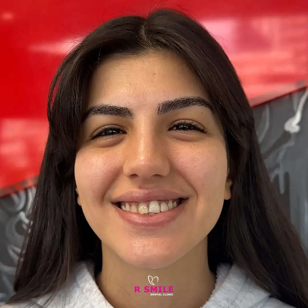 R Smile Dental Clinic diş beyazlatma işlemi öncesi ve sonrası hasta fotoğrafı