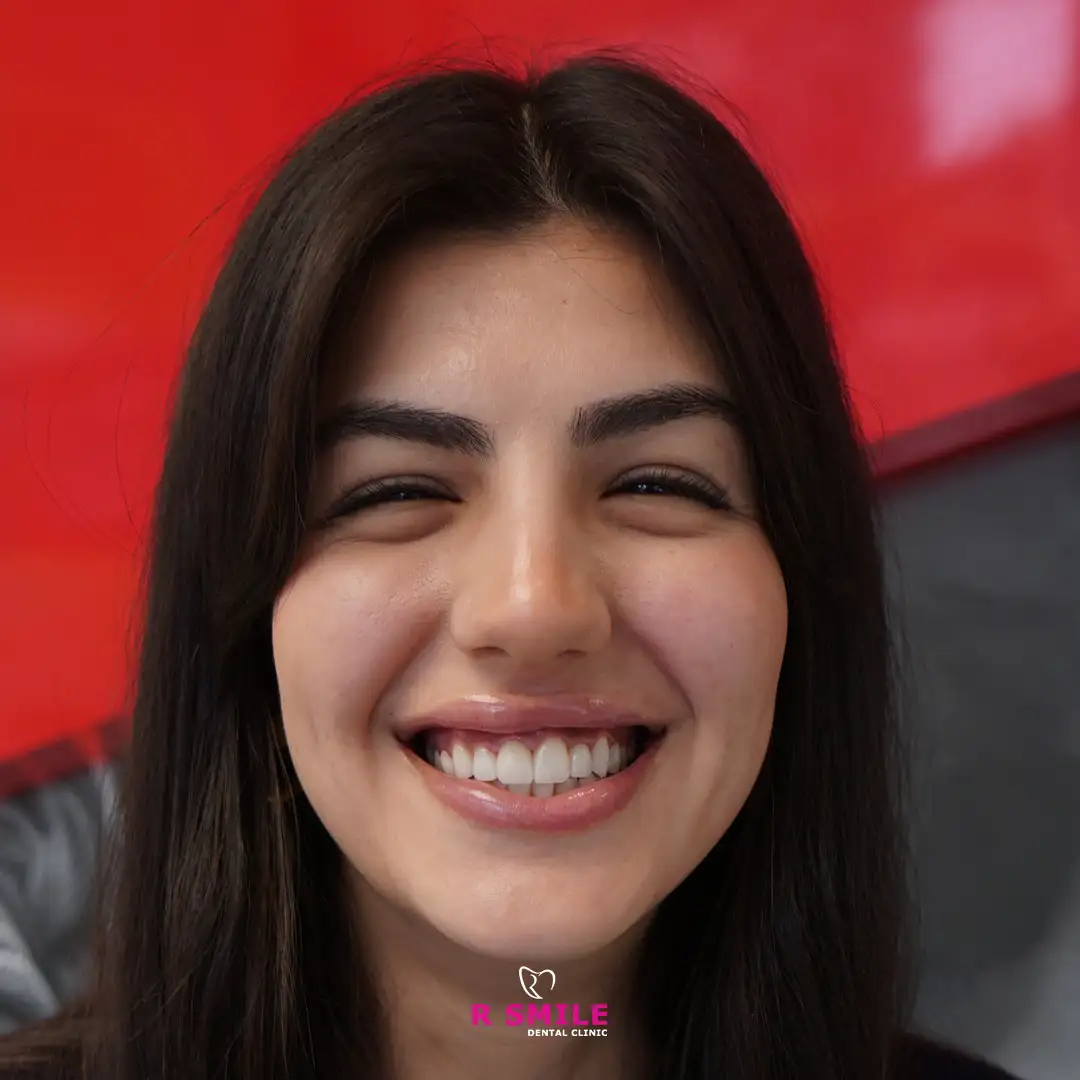 Diş beyazlatma ve estetik tedavi öncesi ve sonrası fotoğraf