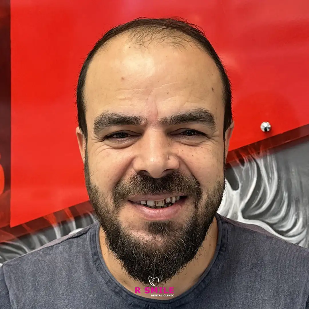 R Smile Dental Clinic implant tedavisi öncesi ve sonrası fotoğrafı