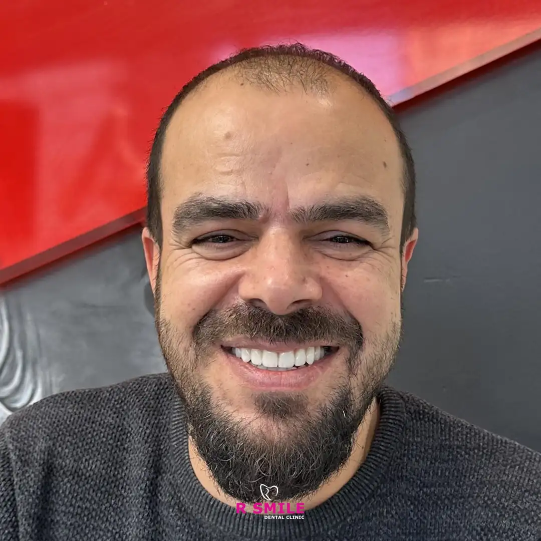Gülüş tasarımı İstanbul'da R Smile Dental Clinic ile başarıyla yapılmış hasta örneği