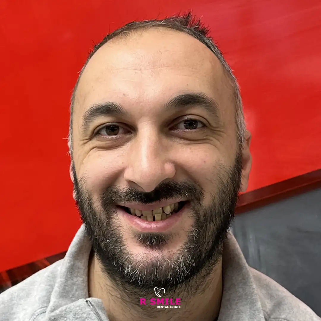 R Smile Dental Clinic ortodonti tedavisi sonucu hasta fotoğrafı